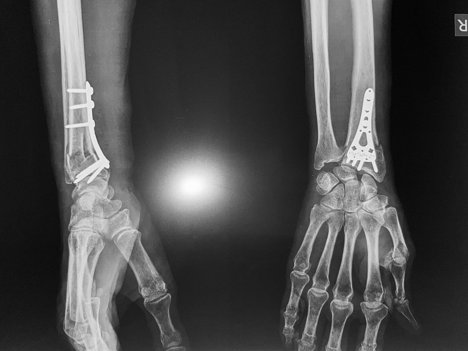 Distal radius fracture, after