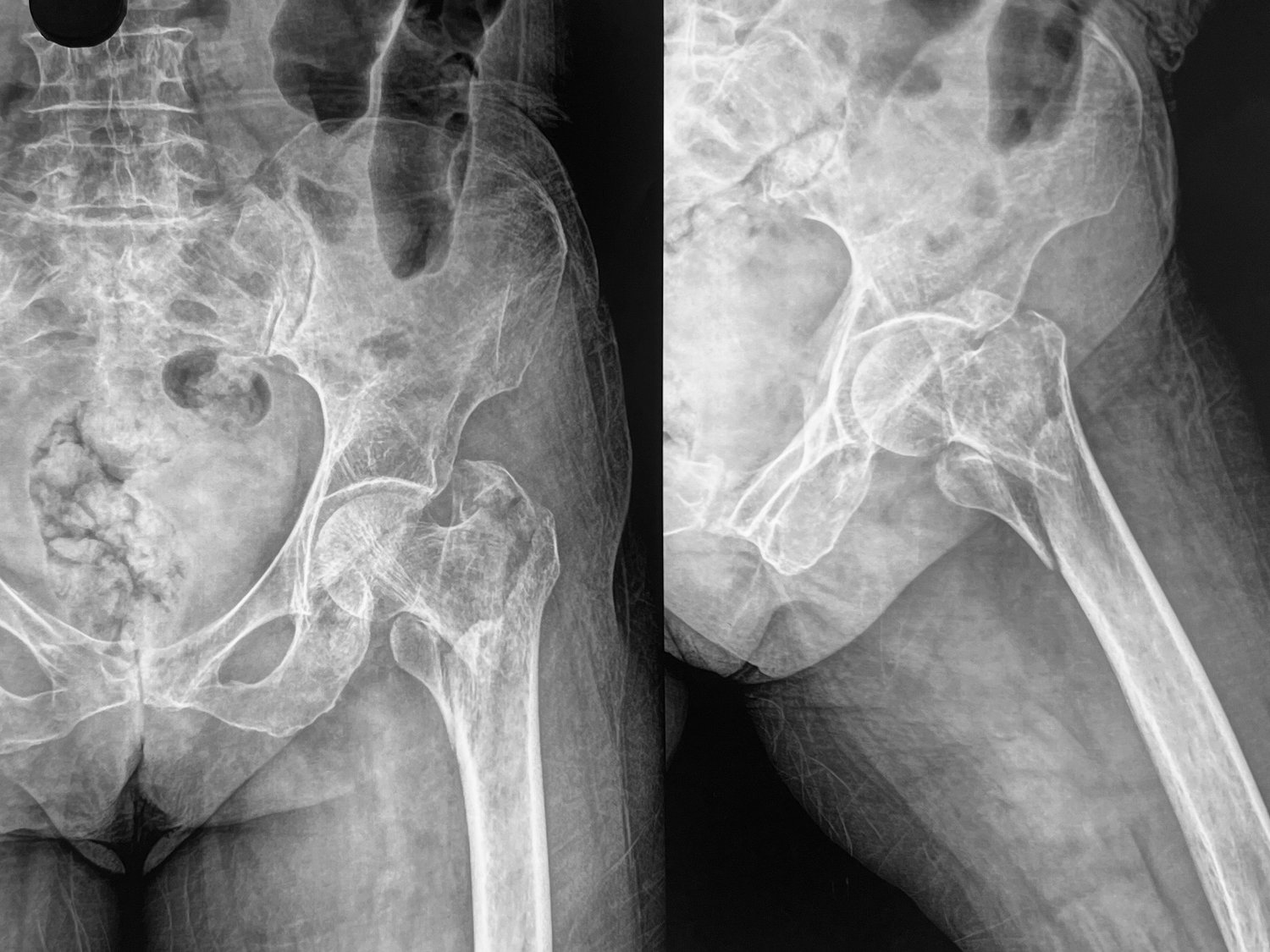 Intertrochanteric hip fracture, before
