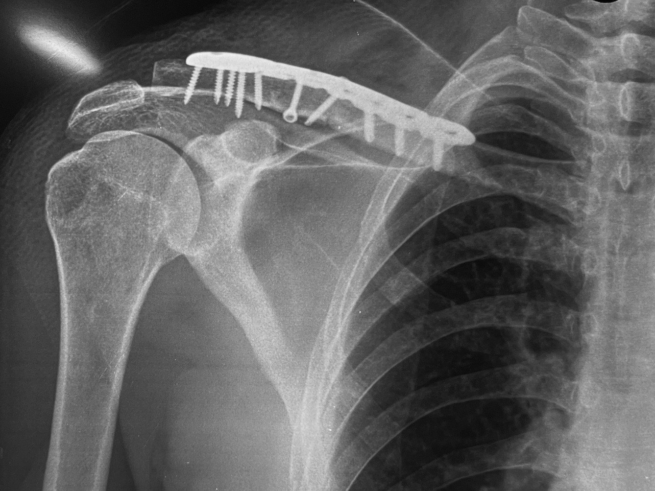 Clavicle fracture, after