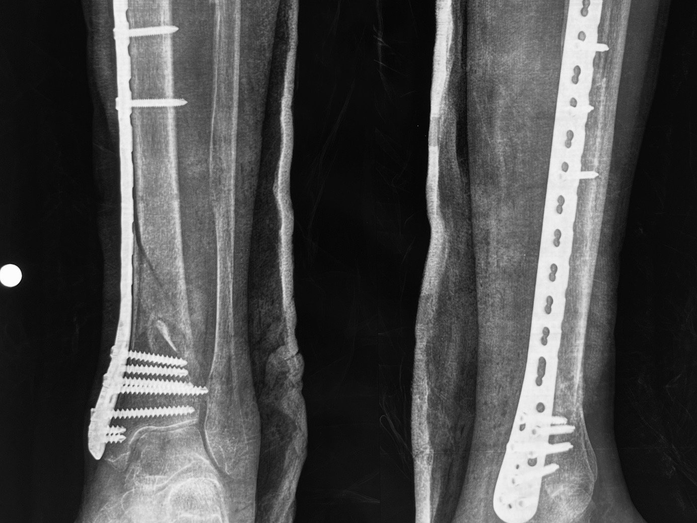 Distal tibia fracture, after