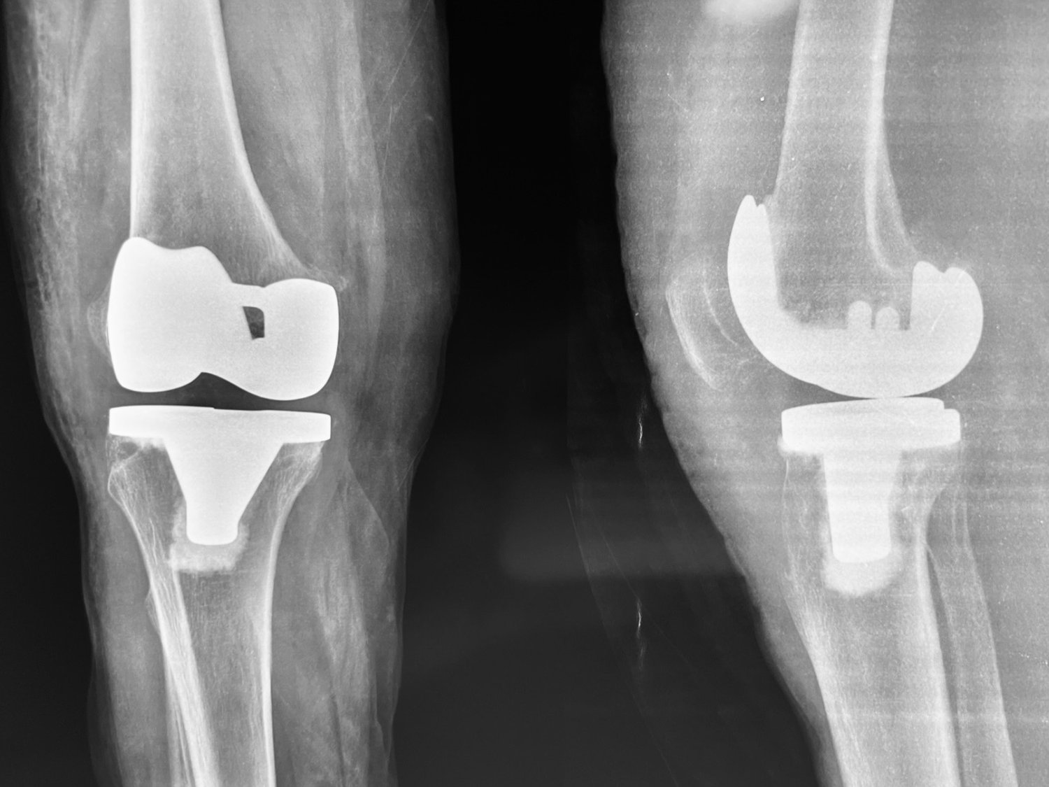 Total knee replacement, after