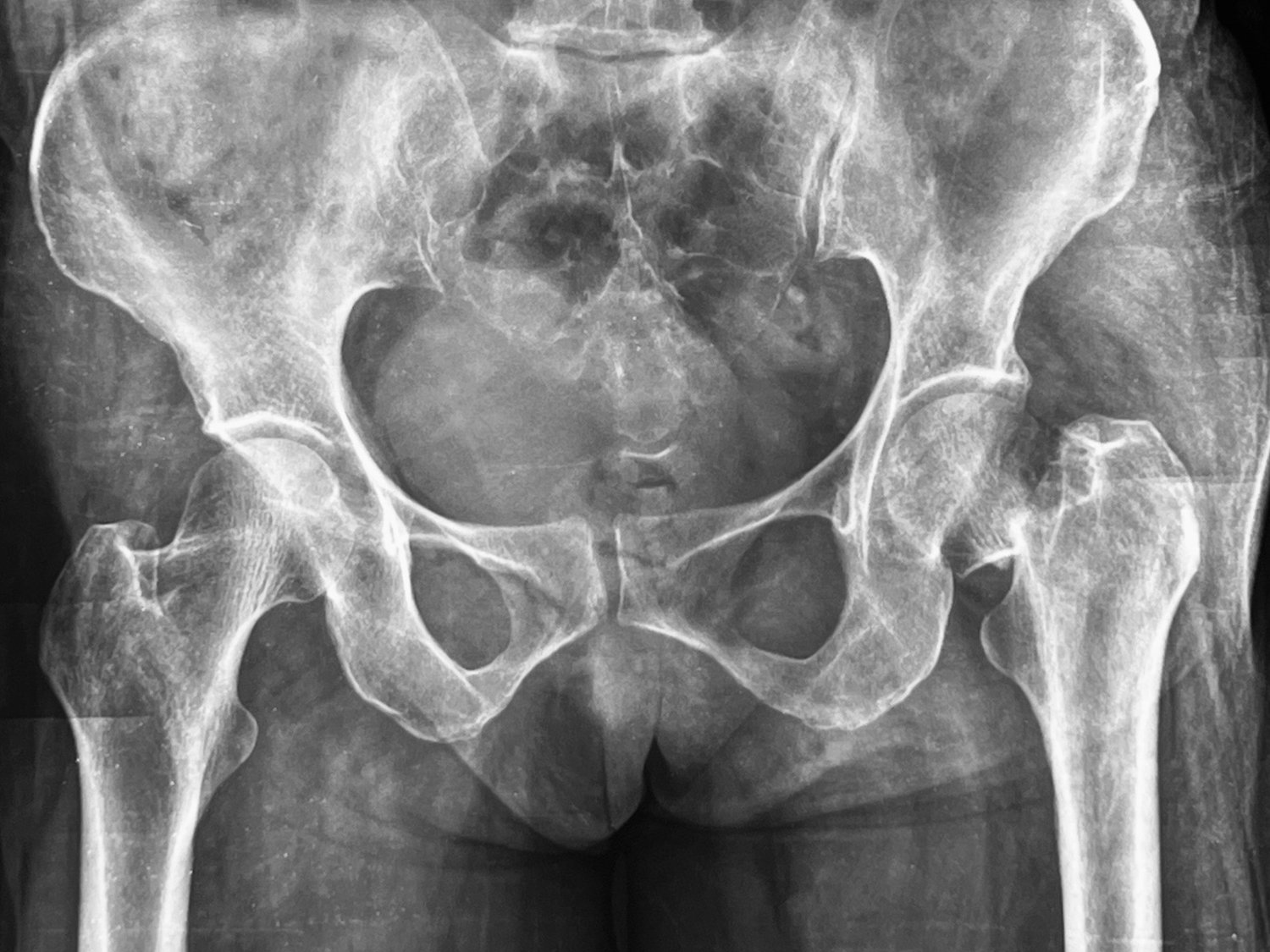 Total hip replacement, before